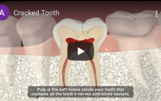 Cracked tooth