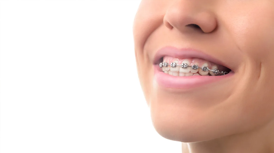 Brace yourself: Number of adults wanting straighter teeth continues to increase Image